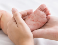 12-я смерть невакцинированного младенца от кори